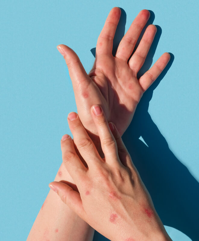 A pair of hands with red, pimple-like bumps